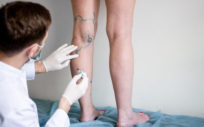 Todo lo que necesitas saber sobre la escleroterapia para venas varicosas